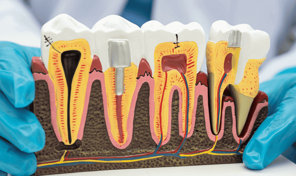 Jibla Dental Center - root Canal